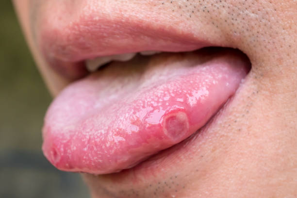Causas de la candidiasis oral una infección común de la boca  Colgate