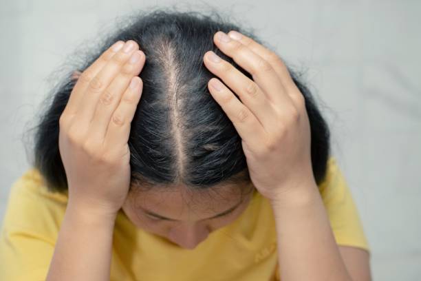 Melodioso ajo granizo Qué es la alopecia? Consejos para disimularla | Pharmacius.comConsejos de  salud y belleza para cuidarte