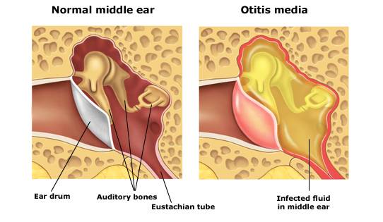 Imagen de Otitis Media Aguda